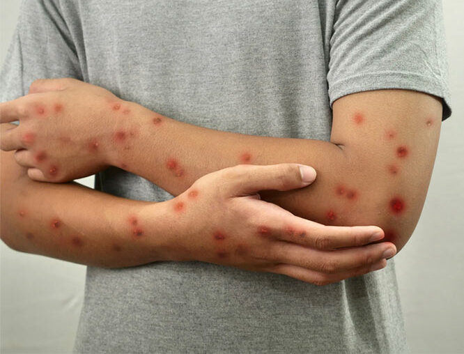 Monkey pox