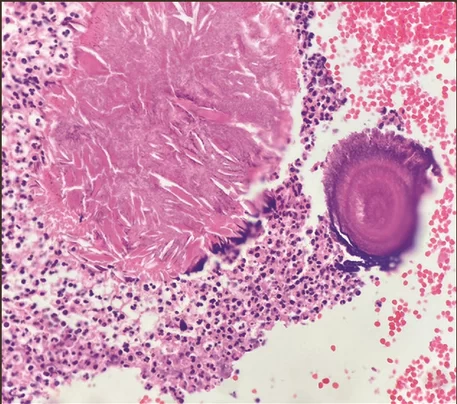Clinical Manifestations of Actinomycosis