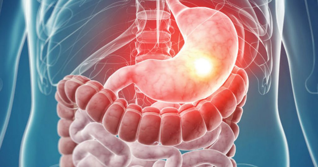 Gastroenteritis